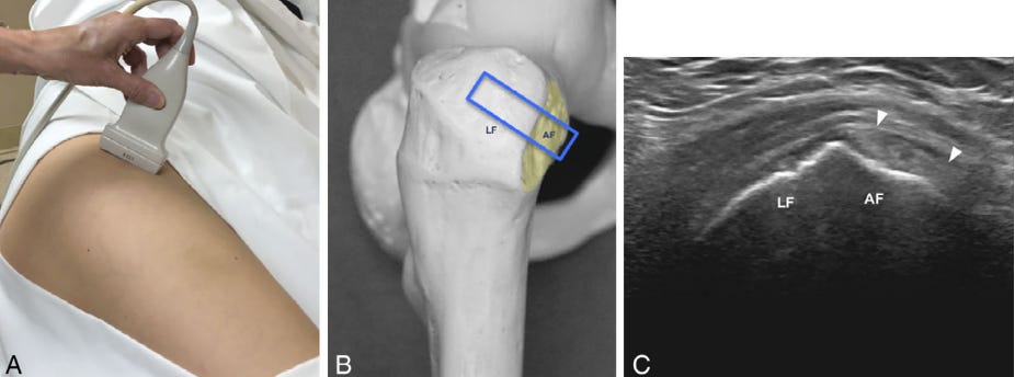 3. Tendon gluteo menor ecografia tempo formacion.jpg